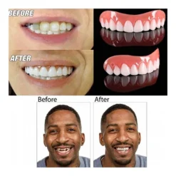 طقم أسنان علوي Perfect Smile قابل للإزالة – ابتسامة فورية بشكل طبيعي - صورة 2