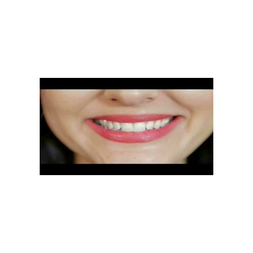 طقم أسنان علوي Perfect Smile قابل للإزالة – ابتسامة فورية بشكل طبيعي - صورة 5